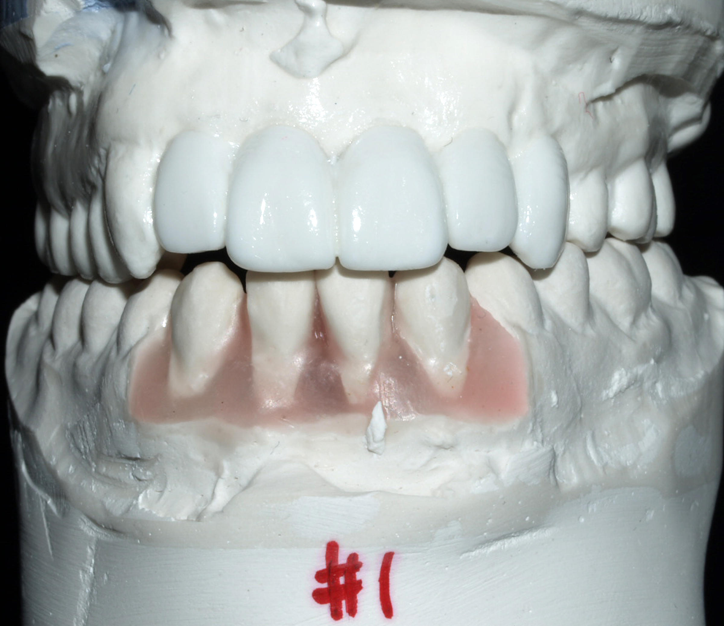 Sterile dental surgical tray and instrument setup prepared for dental implant placement